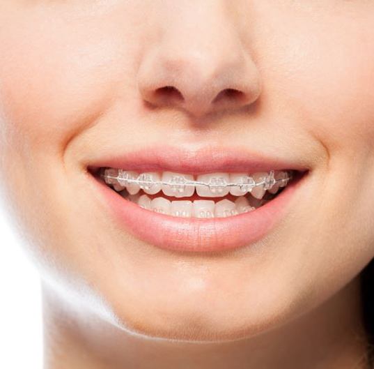 Close-up of young woman’s smile with clear braces