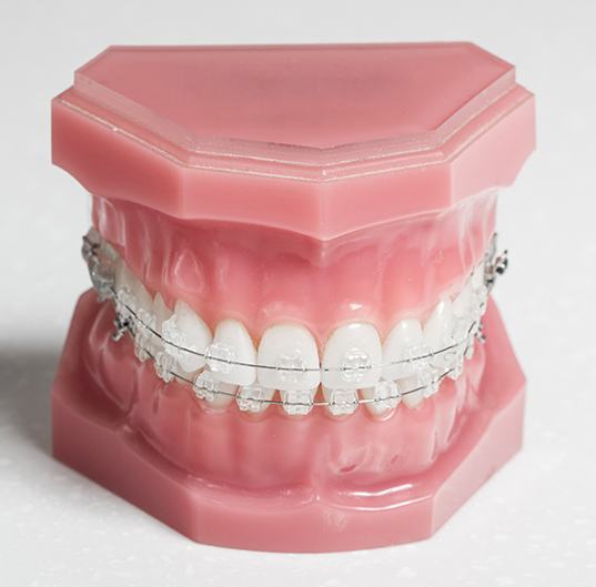 Ceramic braces displayed on dental model